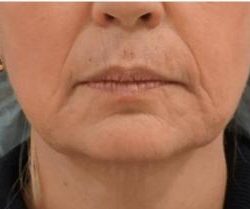 Sofwave Before & After Patient #1603